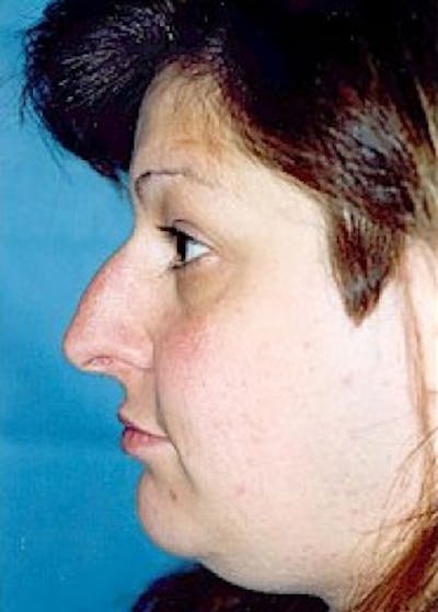 Rhinoplasty Before & After Gallery - Patient 5883978 - Image 1