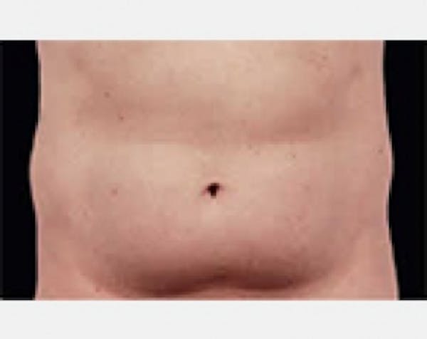 CoolSculpting Gallery - Patient 5883979 - Image 1