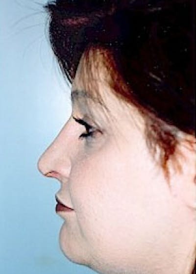 Rhinoplasty Before & After Gallery - Patient 5883978 - Image 2
