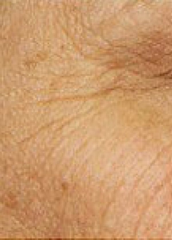 Fraxel Laser Before & After Gallery - Patient 5883980 - Image 1