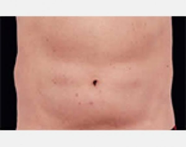 CoolSculpting Gallery - Patient 5883979 - Image 2
