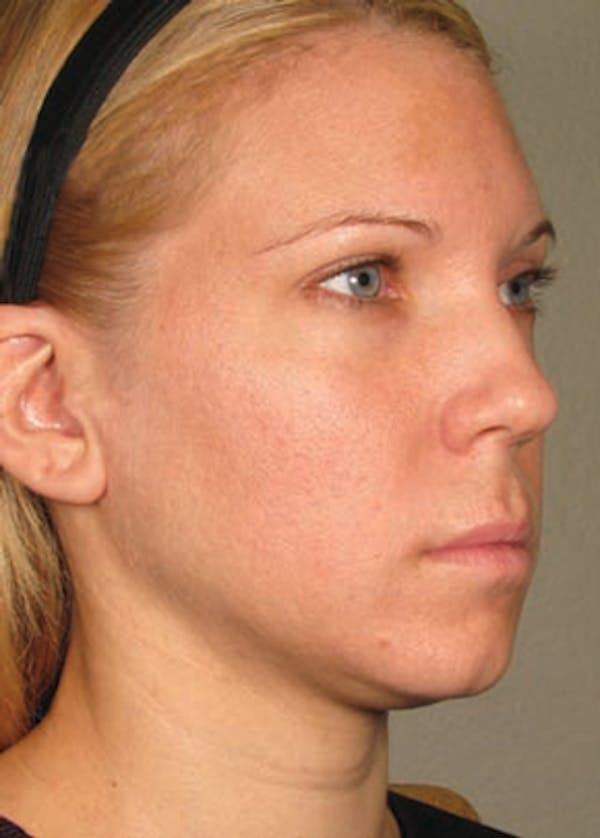 Ultherapy Before & After Gallery - Patient 5883983 - Image 1