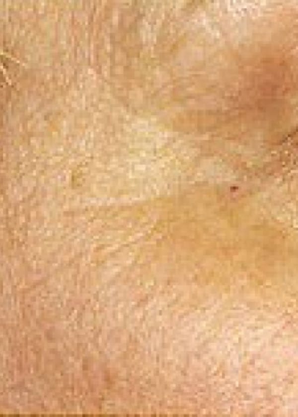 Fraxel Laser Before & After Gallery - Patient 5883980 - Image 2