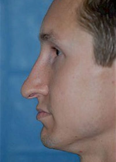 Rhinoplasty Before & After Gallery - Patient 5883981 - Image 1