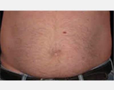 CoolSculpting Gallery - Patient 5883982 - Image 1