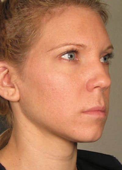 Ultherapy Before & After Gallery - Patient 5883983 - Image 2
