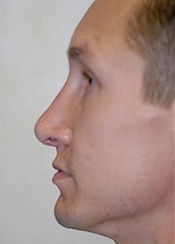 Rhinoplasty Before & After Gallery - Patient 5883981 - Image 2