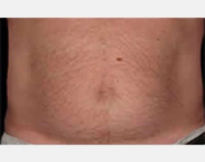 CoolSculpting Before & After Gallery - Patient 5883982 - Image 2