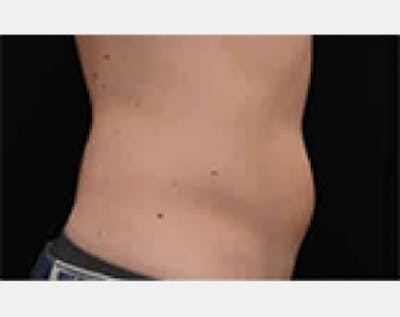 CoolSculpting Before & After Gallery - Patient 5883984 - Image 1