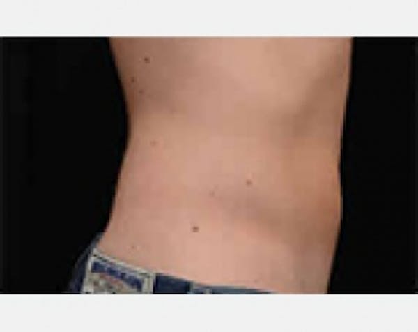 CoolSculpting Gallery - Patient 5883984 - Image 2