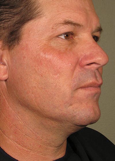 Ultherapy Before & After Gallery - Patient 5883986 - Image 2