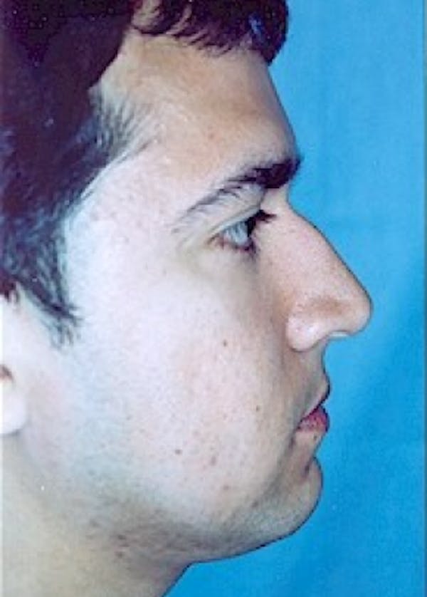 Rhinoplasty Before & After Gallery - Patient 5883990 - Image 3