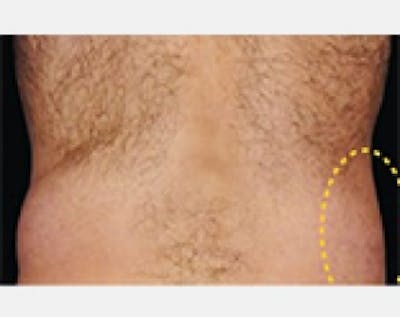 CoolSculpting Before & After Gallery - Patient 5883989 - Image 2