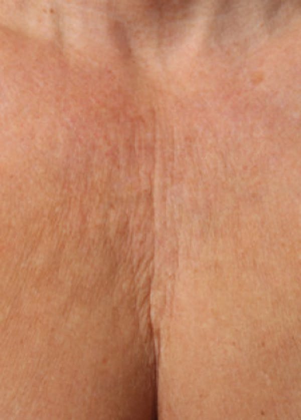Ultherapy Before & After Gallery - Patient 5883993 - Image 1