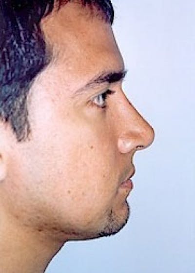 Rhinoplasty Before & After Gallery - Patient 5883990 - Image 4
