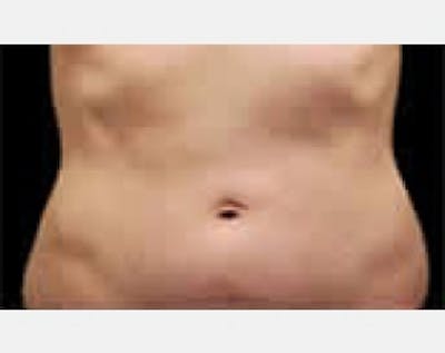 CoolSculpting Before & After Gallery - Patient 5883992 - Image 1