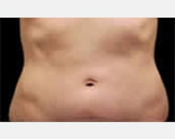 CoolSculpting Before & After Gallery - Patient 5883992 - Image 1