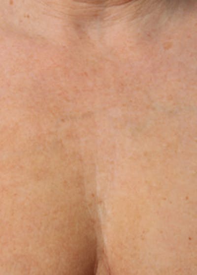 Ultherapy Before & After Gallery - Patient 5883993 - Image 2