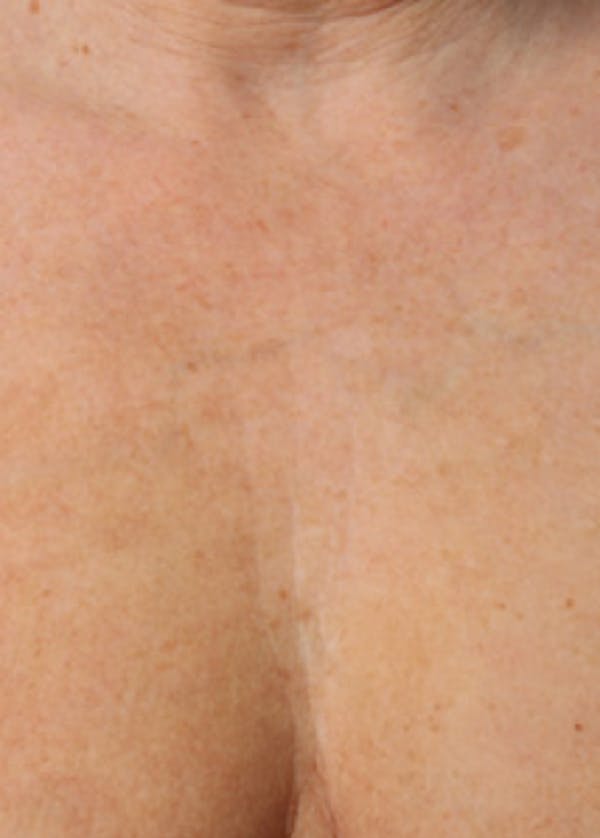 Ultherapy Before & After Gallery - Patient 5883993 - Image 2