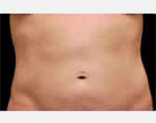 CoolSculpting Before & After Gallery - Patient 5883992 - Image 2