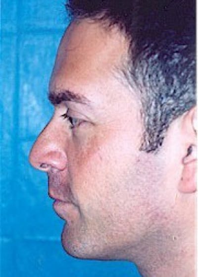 Rhinoplasty Before & After Gallery - Patient 5883994 - Image 1