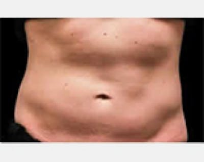 CoolSculpting Before & After Gallery - Patient 5883996 - Image 1