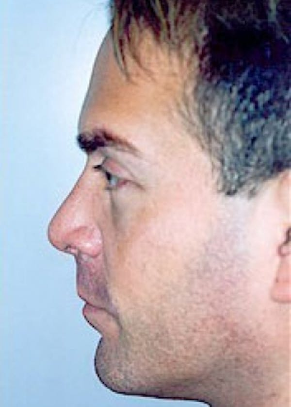 Rhinoplasty Before & After Gallery - Patient 5883994 - Image 2