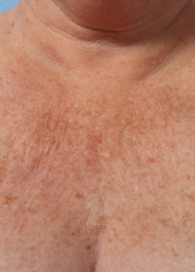 Ultherapy Before & After Gallery - Patient 5883997 - Image 1