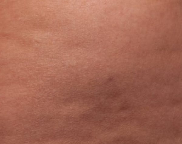 Cellfina Before & After Gallery - Patient 5883995 - Image 2