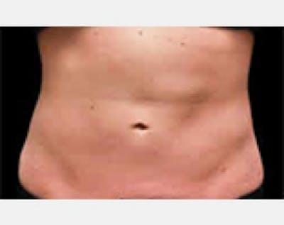 CoolSculpting Gallery - Patient 5883996 - Image 2