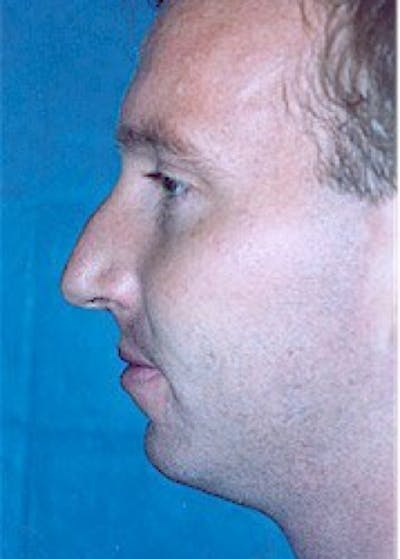 Rhinoplasty Before & After Gallery - Patient 5883998 - Image 1