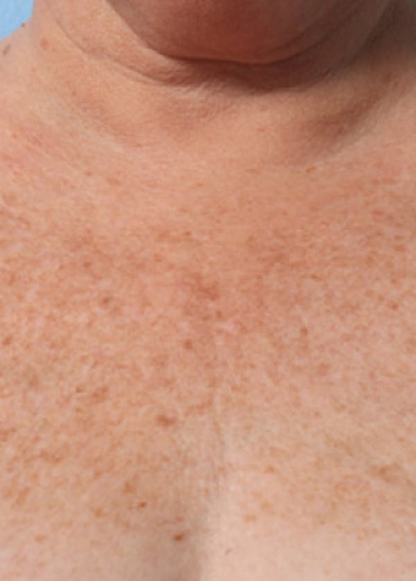 Ultherapy Before & After Gallery - Patient 5883997 - Image 2