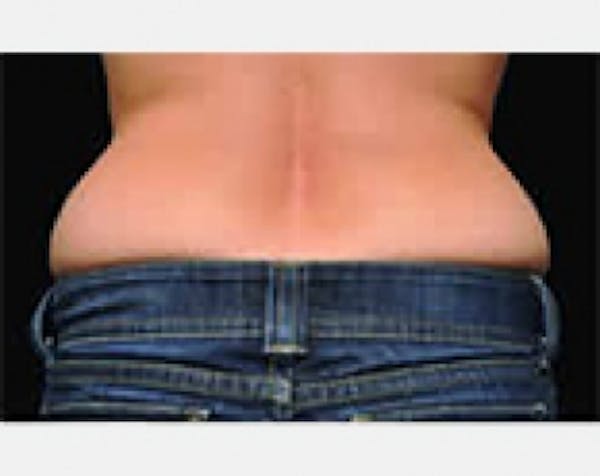 CoolSculpting Before & After Gallery - Patient 5883999 - Image 1