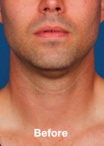 Kybella Before & After Gallery - Patient 5884001 - Image 1