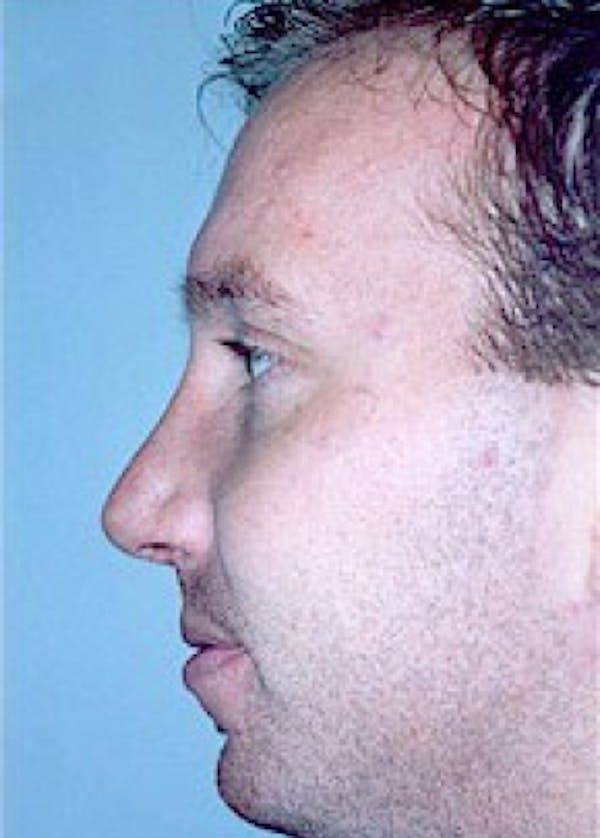 Rhinoplasty Before & After Gallery - Patient 5883998 - Image 2