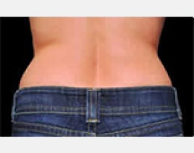 CoolSculpting Before & After Gallery - Patient 5883999 - Image 2