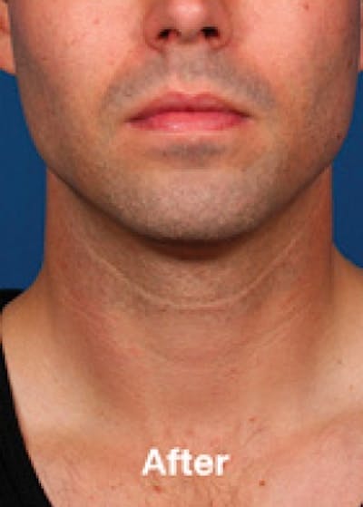 Kybella Before & After Gallery - Patient 5884001 - Image 2