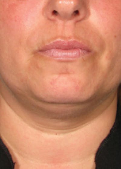 Ultherapy Before & After Gallery - Patient 5884004 - Image 1