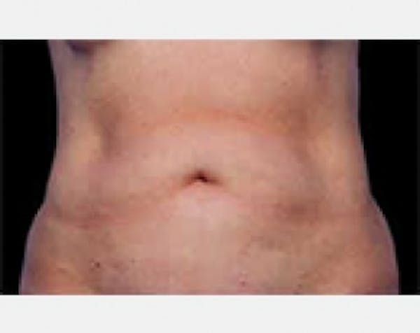 CoolSculpting Gallery - Patient 5884005 - Image 1
