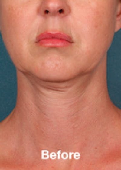 Kybella Before & After Gallery - Patient 5884007 - Image 1
