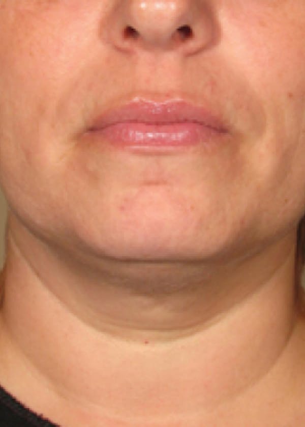 Ultherapy Before & After Gallery - Patient 5884004 - Image 2