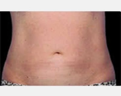 CoolSculpting Before & After Gallery - Patient 5884005 - Image 2