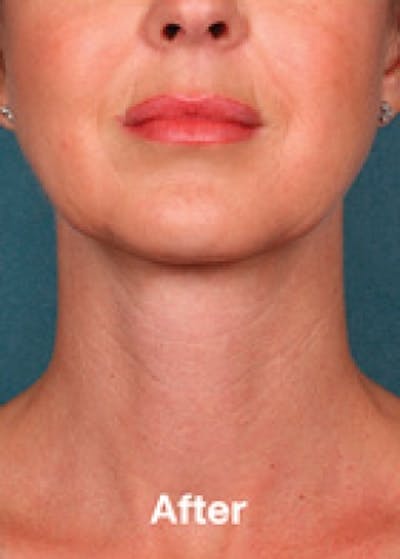 Kybella Before & After Gallery - Patient 5884007 - Image 2