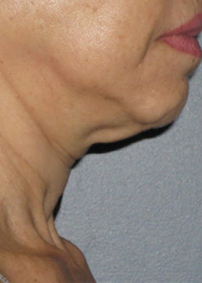 Ultherapy Gallery - Patient 5884010 - Image 1