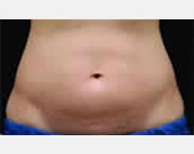 CoolSculpting Before & After Gallery - Patient 5884009 - Image 1