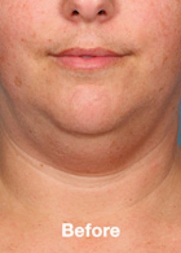 Kybella Before & After Gallery - Patient 5884011 - Image 1
