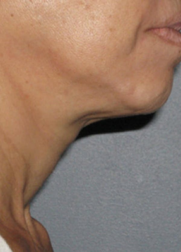 Ultherapy Before & After Gallery - Patient 5884010 - Image 2