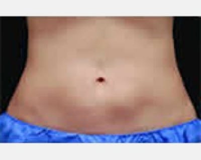 CoolSculpting Before & After Gallery - Patient 5884009 - Image 2