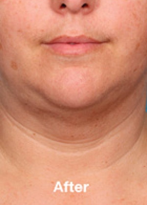 Kybella Before & After Gallery - Patient 5884011 - Image 2
