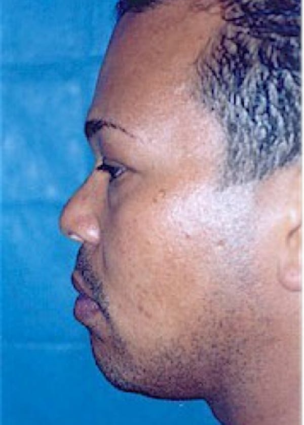 Rhinoplasty Before & After Gallery - Patient 5884016 - Image 3